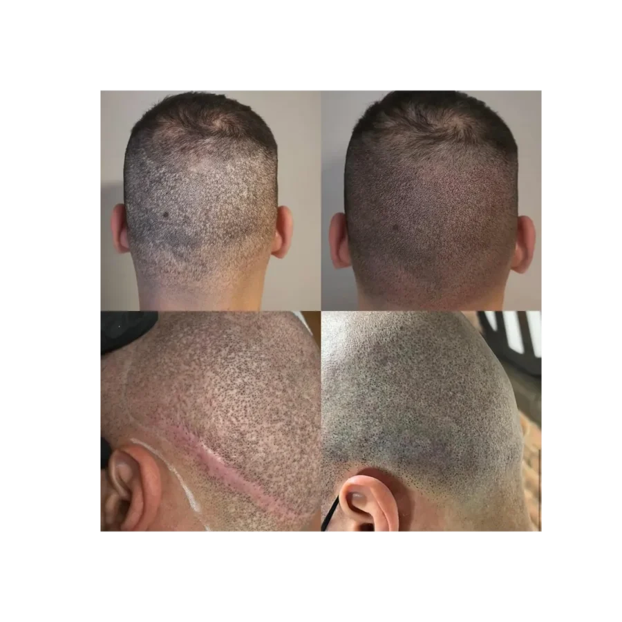 SCALP SCAR CAMOUFLAGE
